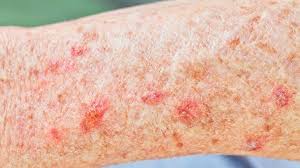 However, unlike ringworm, no itching or scaling is present. 12 Skin Conditions You Should Know About Everyday Health