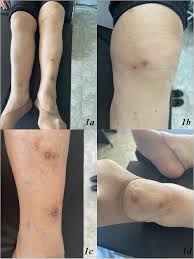 Image result for erythema nodosum