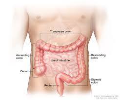 Image result for Colorectal Cancer