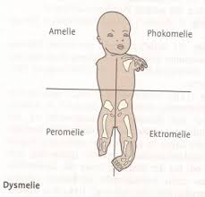 (die hand kann bei einigen patienten normal ausgebildet sein). Flugel Home Spenden Dysmelie Was Ist Das Dysmelien E V Milouwings Herz Dysmelie Was Ist Das Dysmelie Altgr Dys Schlecht Fehl Hier Anomalie Melos Glied Masse Hier Gliedmassen Ist Der Oberbegriff Fur Angeborene
