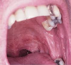 Image result for Aphthasol