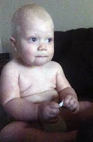 Holčička se narodila s velkým jazykem