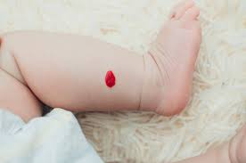 Causes of cherry angioma the specific cause of cherry angiomas remains unknown, but the most likely explanation is random variation in aging cells. Seeing Spots Here S The Deal With Those Bright Red Angiomas Dr Pimple Popper