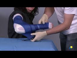 Image result for Long Arm Cast