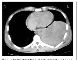 Localized Benign Pleural Mesothelioma A Case Report Semantic Scholar