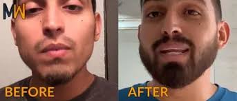 How do you say minoxidil is useful for beard growth.it is clinically not proved and company also not proposed. How To Use Minoxidil For Your Beard Magnum Workshop