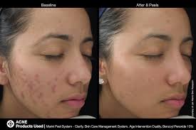 Chemical peels used at home can certainly improve your acne or allow for exfoliation of your skin. Chemical Peels In Westerville Oh Westerville Dermatology