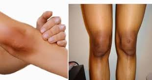 Mengenal teknologi berbasis cahaya sebagai cara menghilangkan bulu permanen. Cara Menghilangkan Daki Dengan Pelembab 5 Cara Memutihkan Mata Kaki Hitam Setelah Jadi Pasta Colek Sedikit Dan Lulurkan Kopi Ke Bagian Leher Yang Berdaki