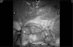 Pelvic Pain Arising From Ovarian Remnant Syndrome Chapter 14 Management Of Chronic Pelvic Pain