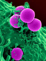 The affected area might be: Methicillin Resistant Staphylococcus Aureus Wikipedia