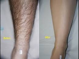 A lot of creams available in the market, in order to remove unwanted hair but it's not permanent and these products also contain chemicals that may damage your skin. Permanent Hair Removal At Home Naturally Ancient Burmese Secret Superwowstyle Y Unwanted Hair Permanently Bikini Hair Removal Unwanted Hair Removal