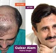 Best FUE Hair Transplant Center in Islamabad Pakistan