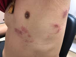 Image result for herpes zoster