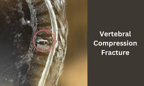 Image result for Vertebral Compression Fracture