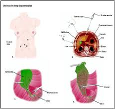 This is a medically induced state of. Cholecystectomy Procedure Recovery Blood Tube Removal Pain Complications Infection