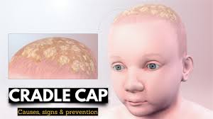 Image result for white scabs on the head in children