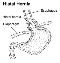 K40.3 hernia inguinal unilateral atau tidak terdiagnosis dengan fenomena oklusi. Hiatal Hernia Wikipedia