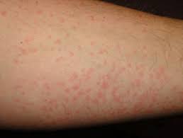 More than any other illness, rhinoviruses (rhin means nose) are associated with the common cold. Cold Urticaria Dermnet Nz