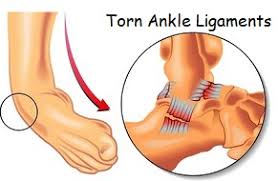 The big toe angles in toward the second toe, and, in severe cases, may overlap or tuck beneath the second toe. Pain On Outside Of Foot Causes Symptoms Treatment