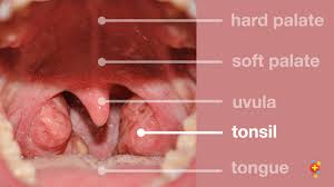 Image result for Tonsillitis