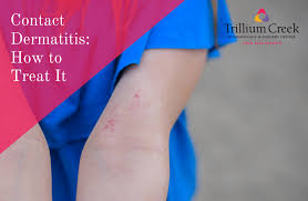 Image result for Contact Dermatitis