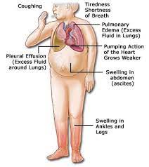 Certain kidney conditions that increase blood pressure and fluid buildup can increase the risk of chf by placing more stress on the heart. Mater Misericordiae Heart Failure Service Heart Failure Symptoms Fluid In Lungs Heart Failure