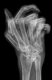 Image result for XRay Changes in Rheumatic Conditions