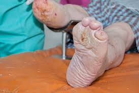 Image result for toe amputation