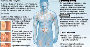 O linfoma não hodgkin é um tipo de cancro hematológico. Blog Bond De Sergipe Saude Linfoma Nao Hodgkin