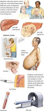 The other ways this disease spreads to animals or humans is typical signs and symptoms include a varying severity and combination of productive or dry cough, chest pain, fever, and trouble breathing. Liver Cancer Upper Gi Cancers Spectrum Health