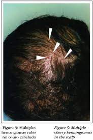 Normally they are multiplex spots and focus predominantly on the upper trunk and arms. Cherry Hemangioma In The Scalp
