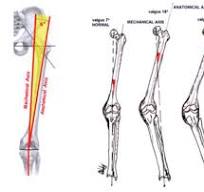 Valgus Deformity Correction in Total Knee Replacement: An ...
