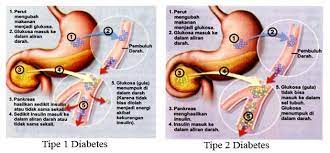 Kencing manis juga dikenali sebagai diabetes mellitus dalam istilah perubatan. Diabetes Diabetes Tahap 2