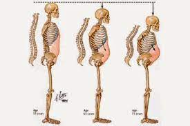 Kemik erimesi, osteoporoz da denilen bir rahatsızlıktır. Iste Kemik Erimesine Ilac Gibi Gelen Mucizevi 2 Malzeme Kocaeli Haberleri