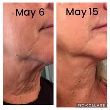 Neora's Neo-FILLER is delivering remarkable results once again! With  consistent daily use over just 5–9 weeks, the transformation speaks for  itself. While individual results may vary, many users experience visible,  noticeable improvements—especially