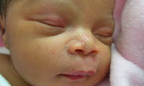 Bukan semua kaedah atau cara hilangkan kahak bayi yang dikongsikan di atas akan berjaya, namun sebagai ibu bapa, tidak salah untuk mencubanya sebagai ikhtiar, bukan? Ruam Bayi Baru Lahir Mana Yang Selamat Dan Yang Perlukan Rawatan