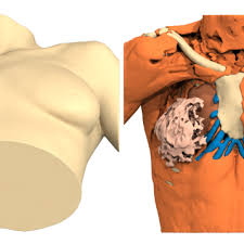 Sie treten wesentlich häufiger bei männern auf und können mit hilfe eines thoraximplatates operativ korrigiert. Aktuelles Anatomikmodeling