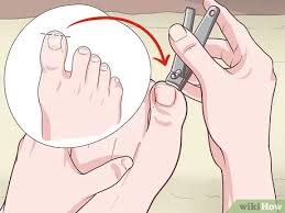 Jul 27, 2017 · alleviate pain. 3 Ways To Cut An Ingrown Toenail Wikihow Life