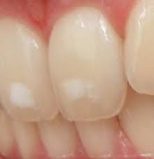 Maybe you would like to learn more about one of these? White Spots On Teeth 11 Tips On How To Get Rid Of Them