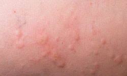 5 Skin Disorders You Might Mistake For Hives Essential Oils For Rash Essential Oil For Hives Itching Skin