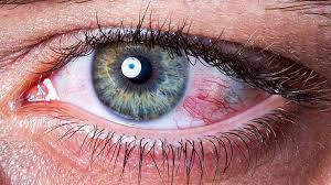 Image result for Eye Pain without Redness