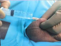 ¿qué sucede durante una vasectomía sin bisturí? Vasovasostomia Reversibilidad De La Vasectomia Vaso Vaso