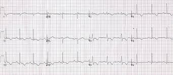 Image result for Epsilon Wave