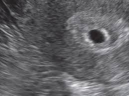 1 Ultraschalluntersuchung In Der Schwangerschaft Onmeda De