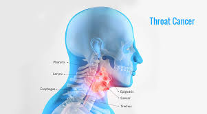 What are 18 signs and symptoms of cancer? Throat Cancer Causes Symptoms And Effective Homeopathic Treatment
