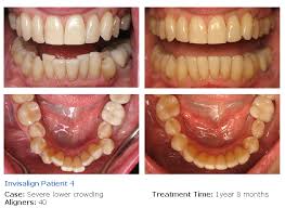 See full list on drarocha.com Invisalign Dentist Westlake Village Ca
