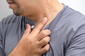 Cauterization is basically the use of electricity to burn the cells in your skin tags under the eyes and kill them immediately. At Home Skin Tag Mole Removers Are They Safe Blog