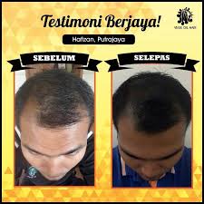Apakah penyebab rambut gugur setiap hari dan apakah cara merawat keguguran rambut? Pakar Rawatan Rambut Gugur Dan Botak Anda Publications Facebook
