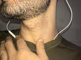 Ingrown hair treatment (anthony) #manscaping #lifestyle looking for the best manscaping tips to keep your body in check? How I Can Prevent This Ingrown Irritation Hair On My Neck Wicked Edge