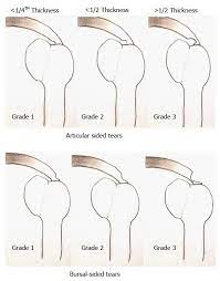 Rotator Cuff Tears An Evidence Based Approach